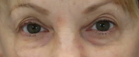 before eyelid surgery front view of female patient 5735