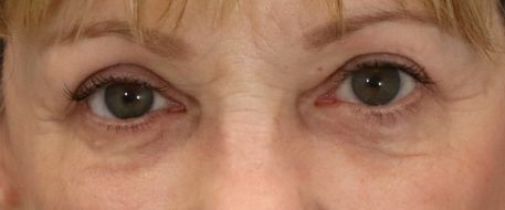 after eyelid surgery front view of female patient 5735