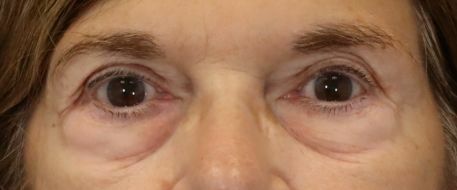 before eyelid surgery front view of female patient 5738
