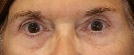 after eyelid surgery front view of female patient 5738