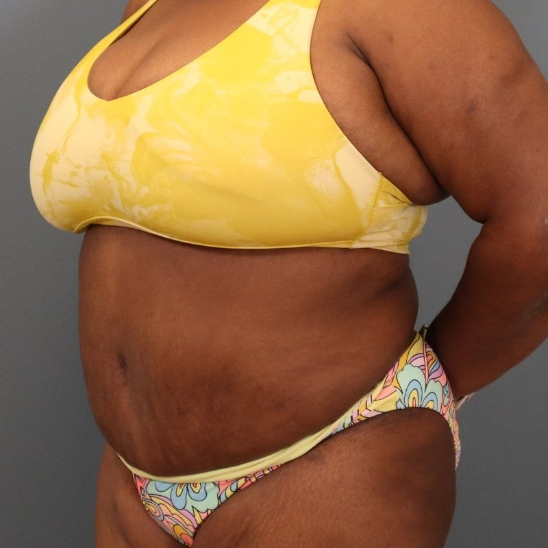 after tummy tuck left angle view of female patient 5680