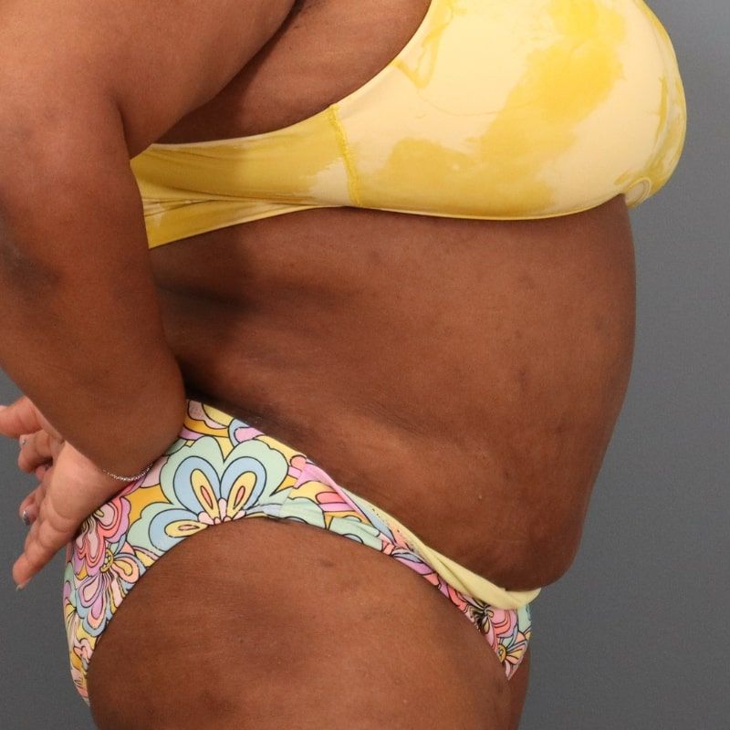 after tummy tuck right side view of female patient 5680