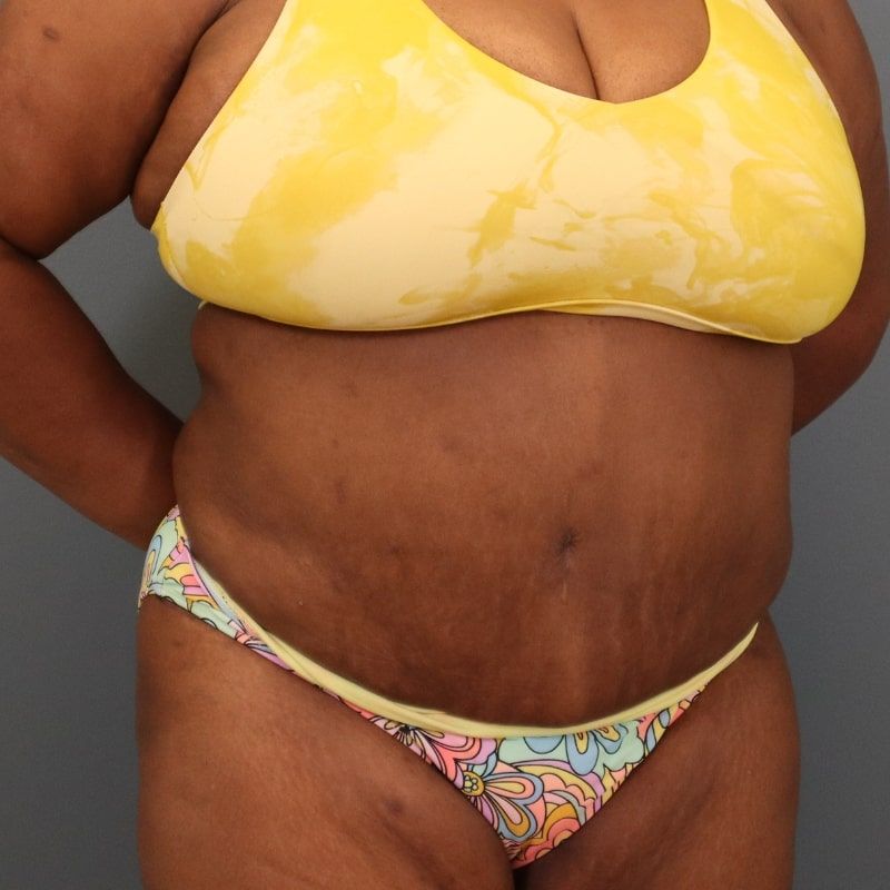 after tummy tuck right angle view of female patient 5680