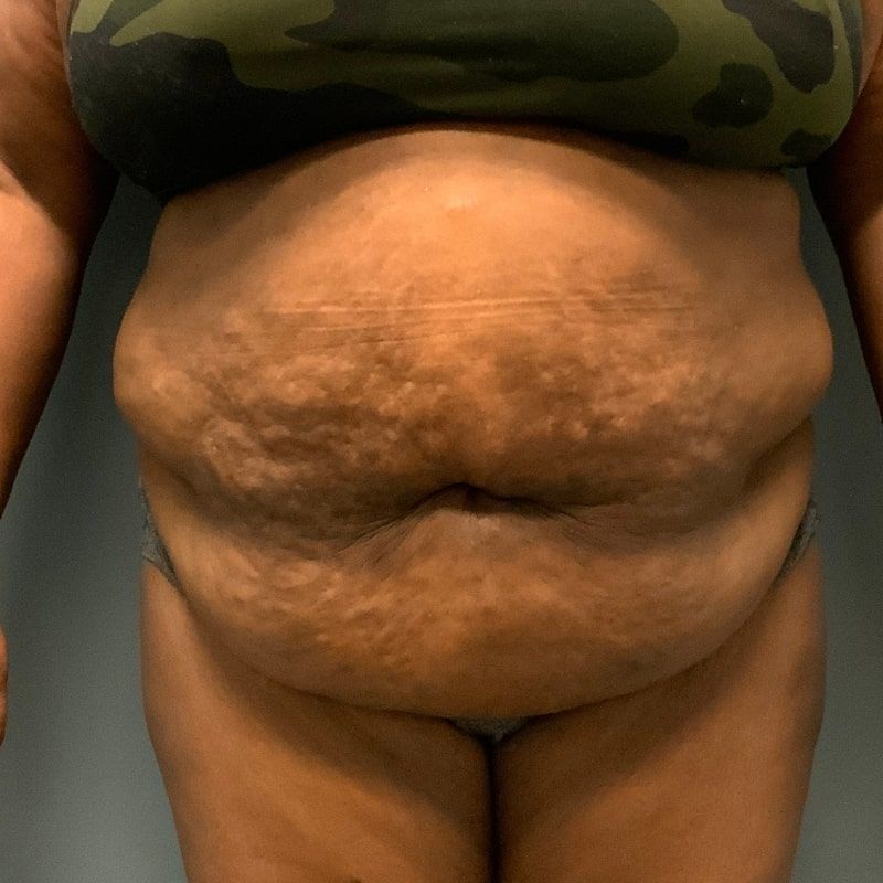 before tummy tuck front view of female patient 5680
