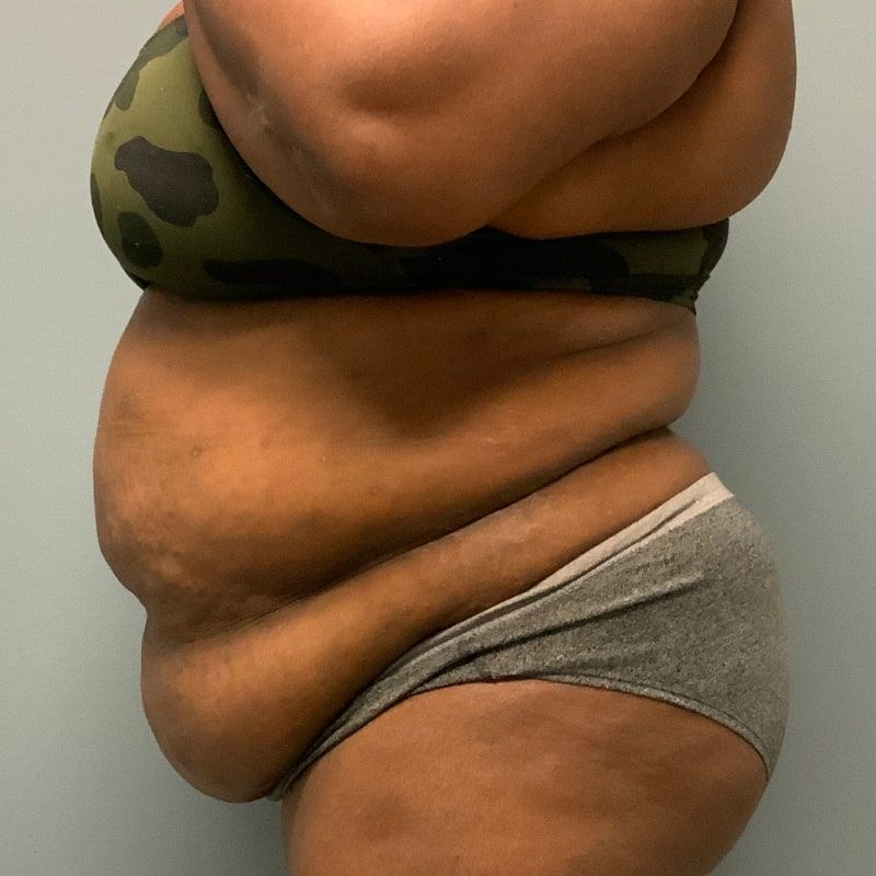 before tummy tuck left side view of female patient 5680