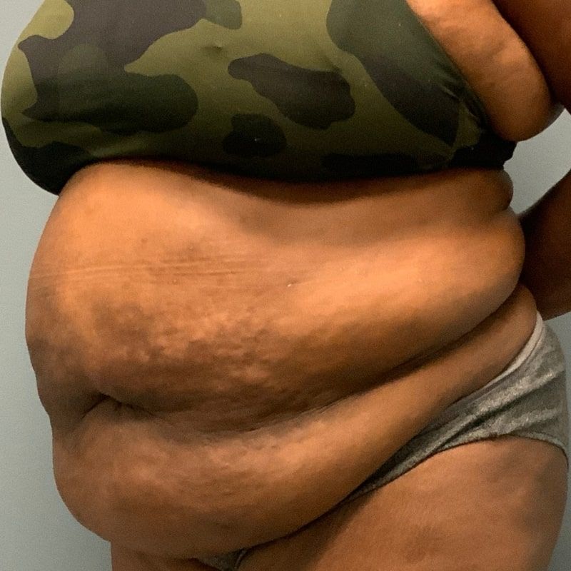 before tummy tuck left angle view of female patient 5680