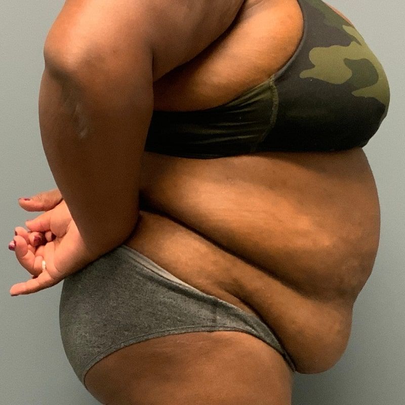 before tummy tuck right side view of female patient 5680