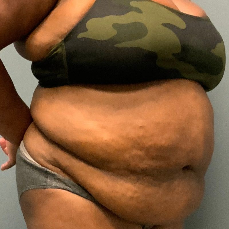 before tummy tuck right angle view of female patient 5680
