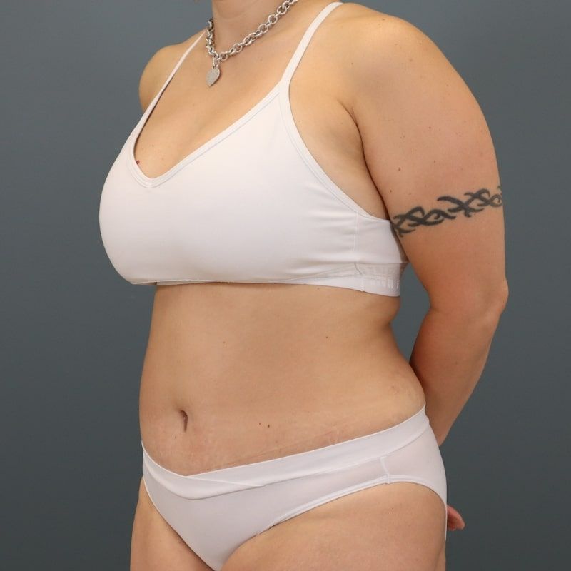 after tummy tuck left angle view of female patient 5691