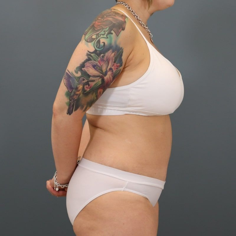 after tummy tuck right side view of female patient 5691