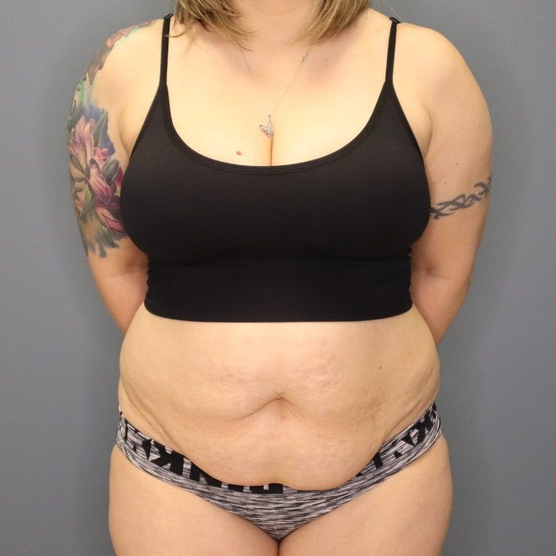 before tummy tuck front view of female patient 5691