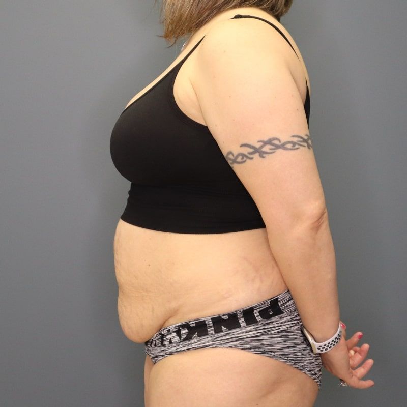 before tummy tuck left side view of female patient 5691
