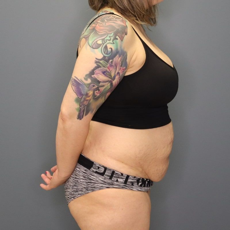 before tummy tuck right side view of female patient 5691