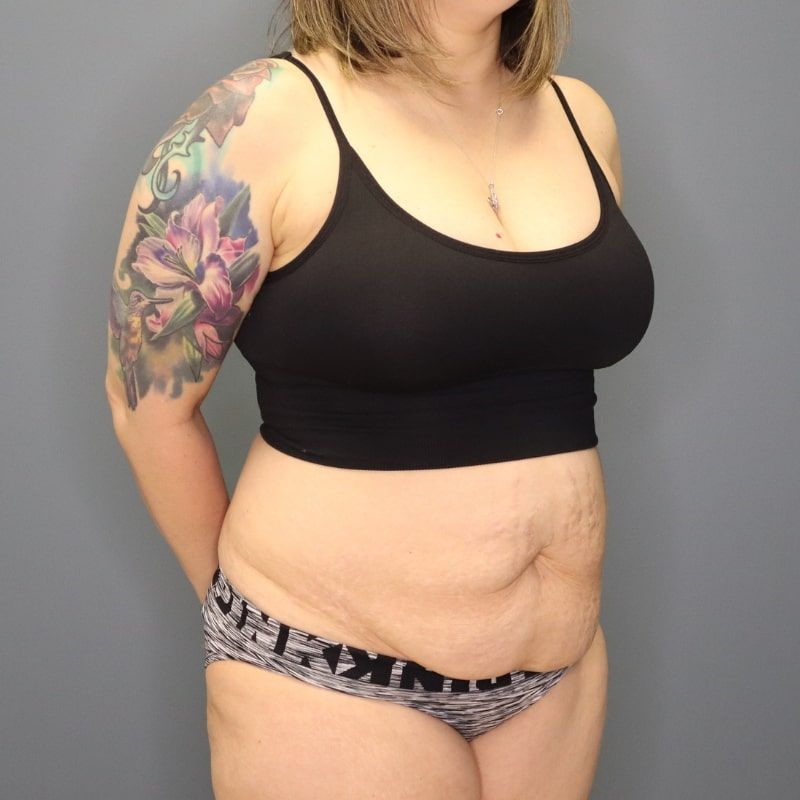 before tummy tuck right angle view of female patient 5691