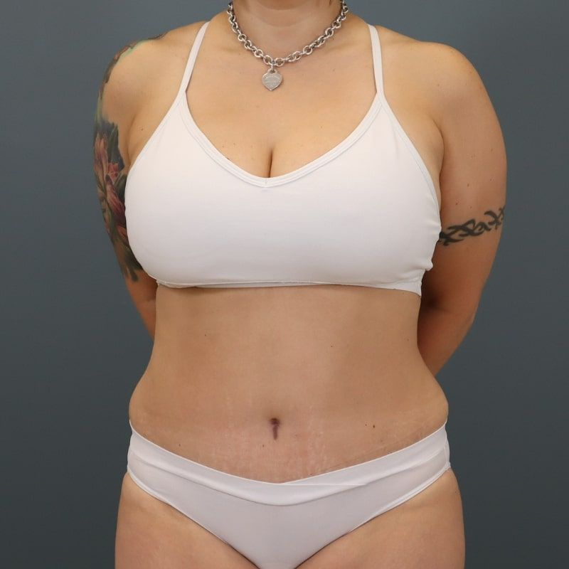 after tummy tuck front view of female patient 5691
