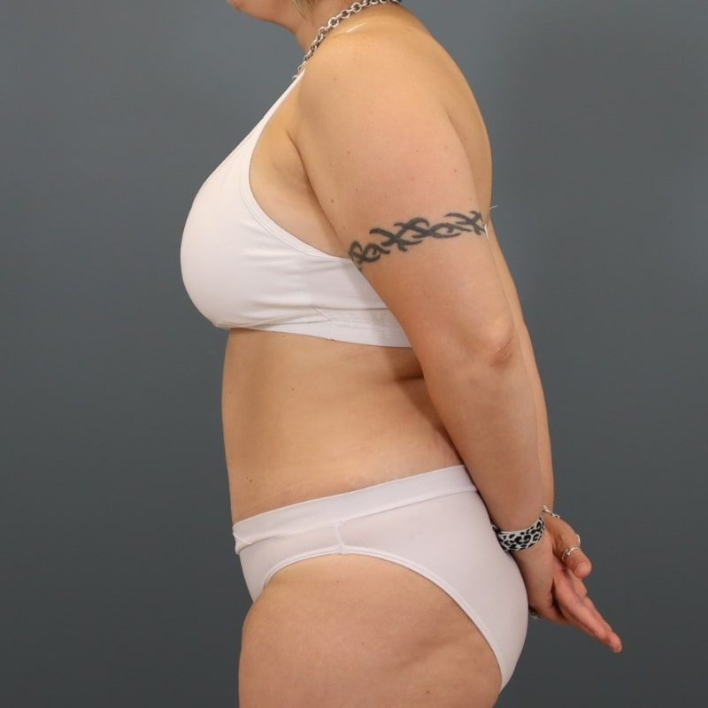 after tummy tuck left side view of female patient 5691