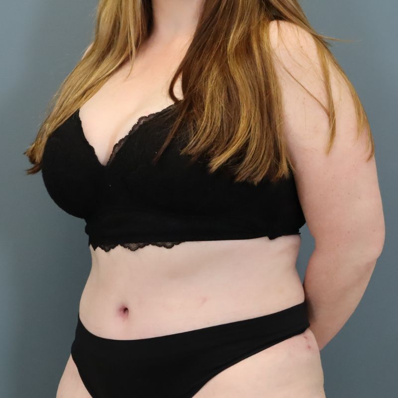 after tummy tuck left angle view of female patient 5702