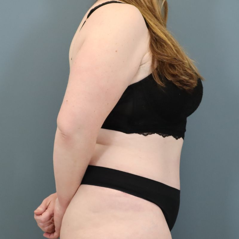 after tummy tuck right side view of female patient 5702