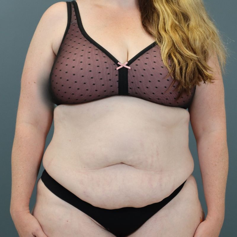 before tummy tuck front view of female patient 5702