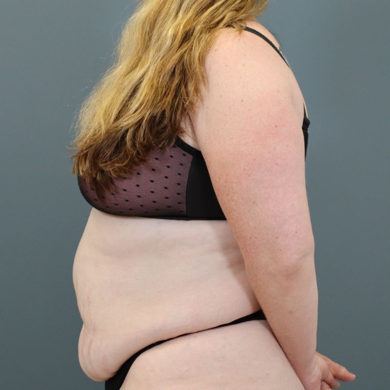before tummy tuck left side view of female patient 5702
