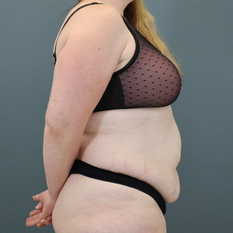 before tummy tuck right side view of female patient 5702