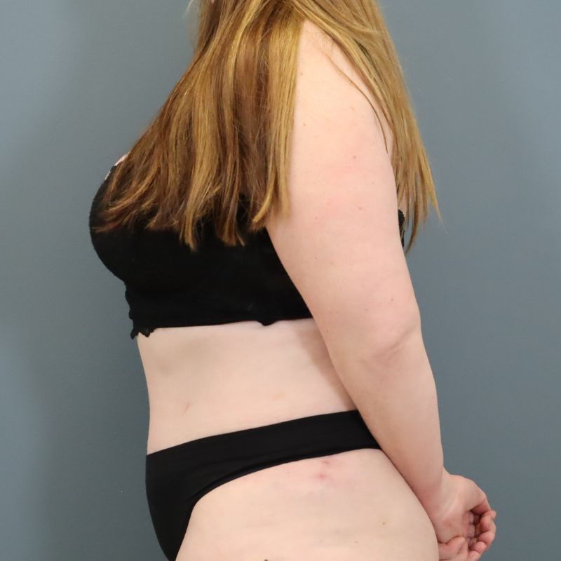 after tummy tuck left side view of female patient 5702