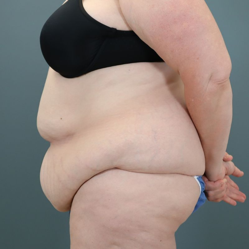 before tummy tuck left side view of female patient 5713