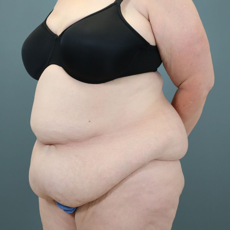 before tummy tuck left angle view of female patient 5713