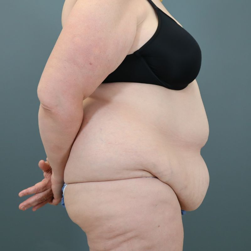 before tummy tuck right side view of female patient 5713