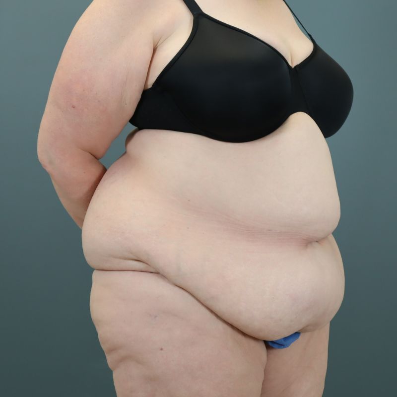 before tummy tuck right angle view of female patient 5713