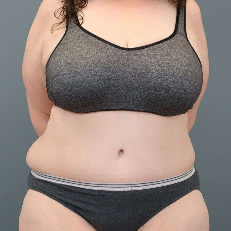 after tummy tuck front view of female patient 5713