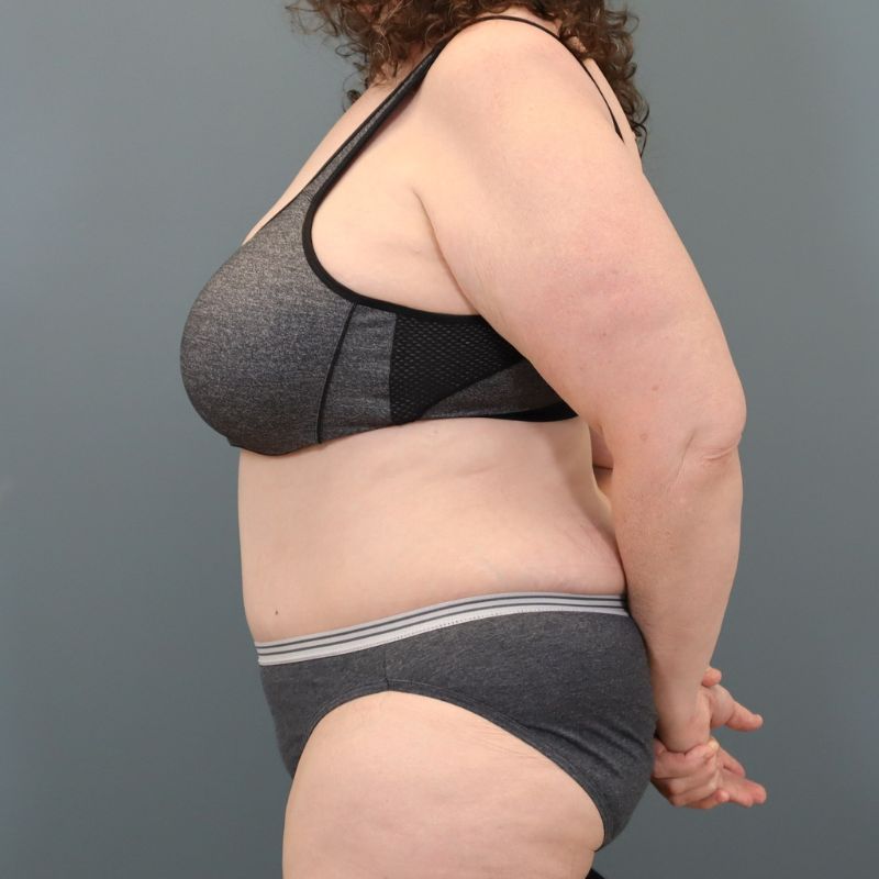 after tummy tuck left side view of female patient 5713
