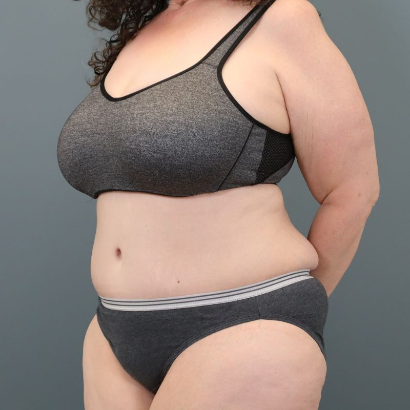 after tummy tuck left angle view of female patient 5713