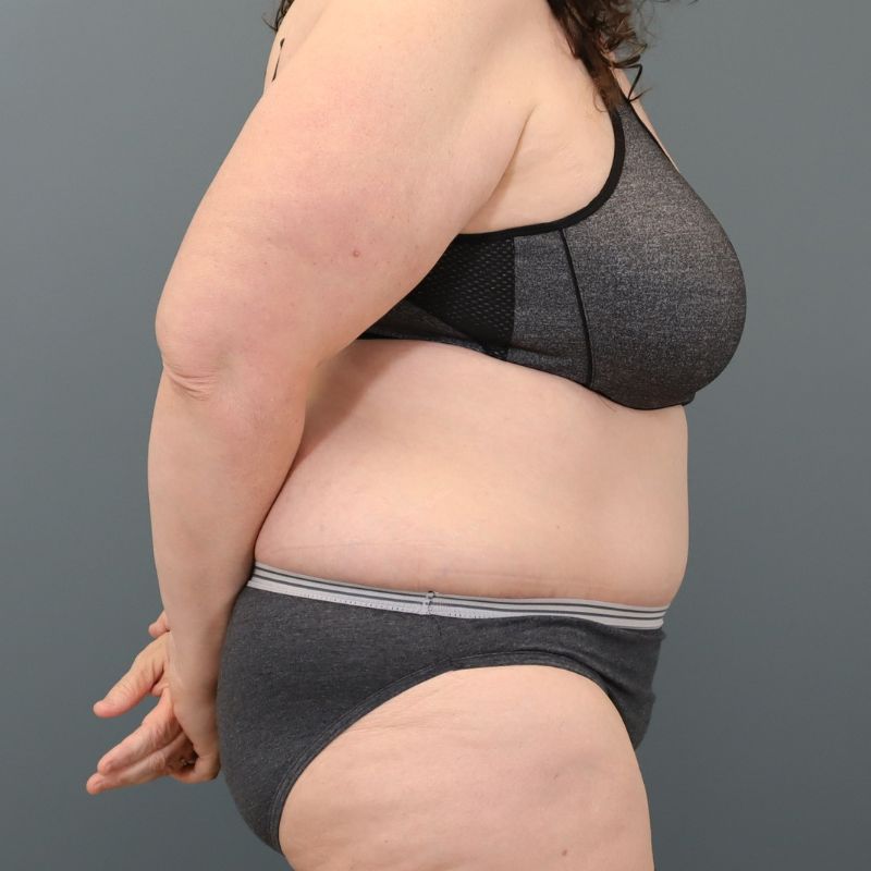 after tummy tuck right side view of female patient 5713
