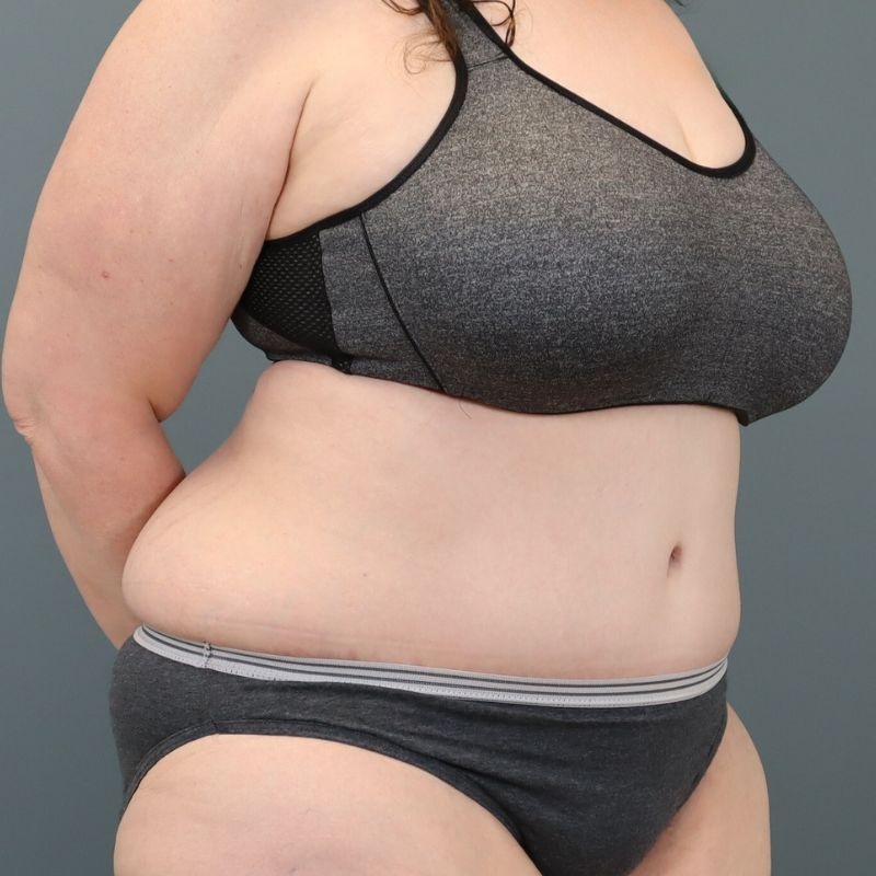 after tummy tuck right angle view of female patient 5713