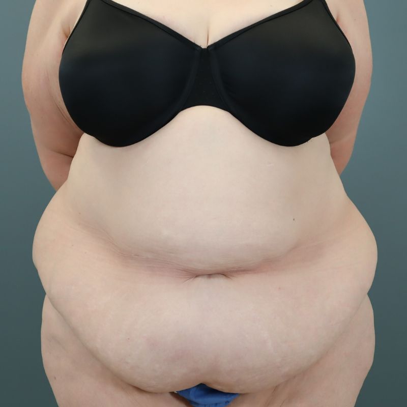 before tummy tuck front view of female patient 5713