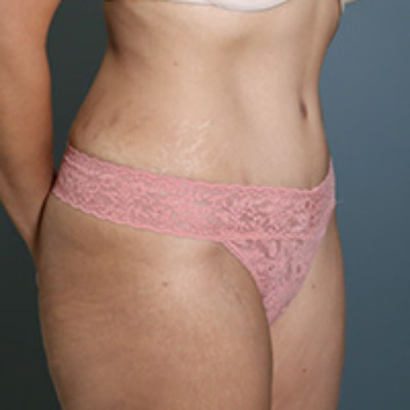 after tummy tuck right angle view of female patient 5602