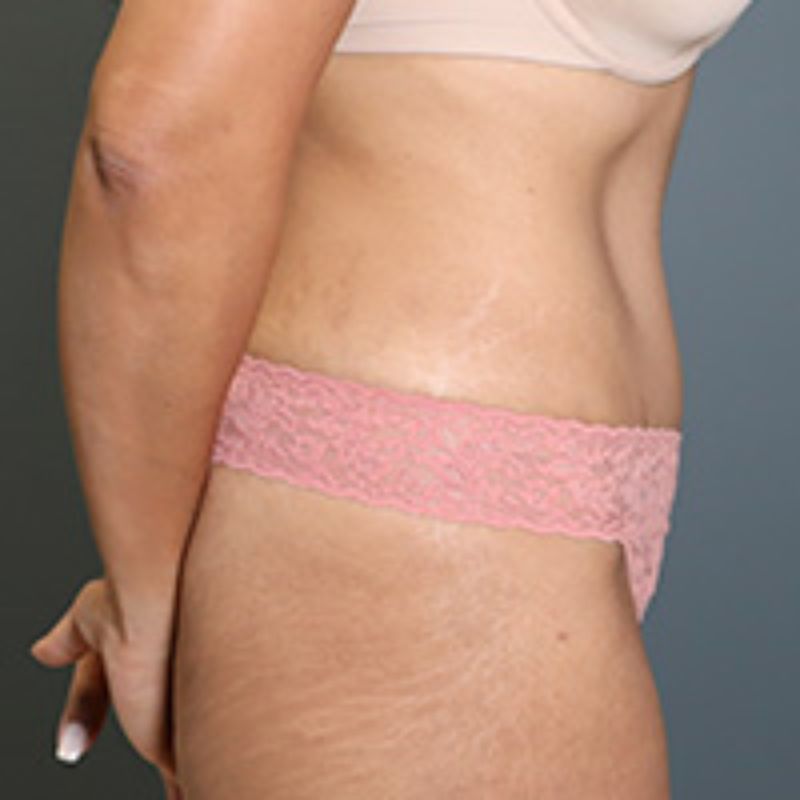 after tummy tuck right side view of female patient 5602