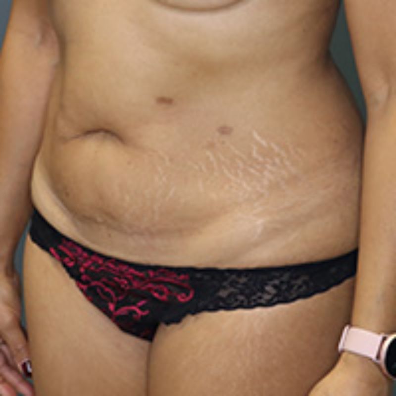 before tummy tuck left angle view of female patient 5602