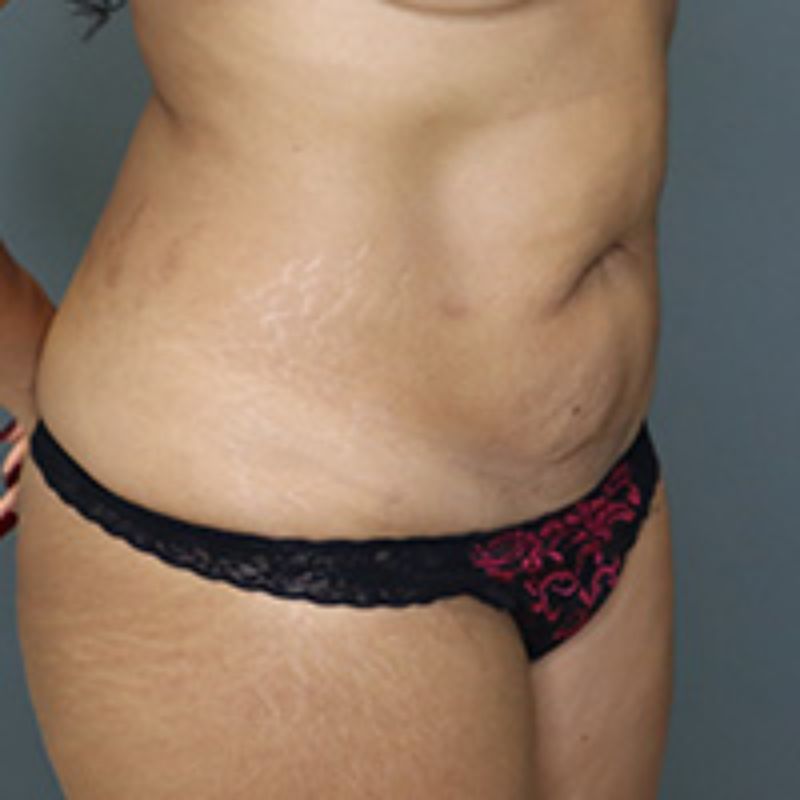 before tummy tuck right angle view of female patient 5602
