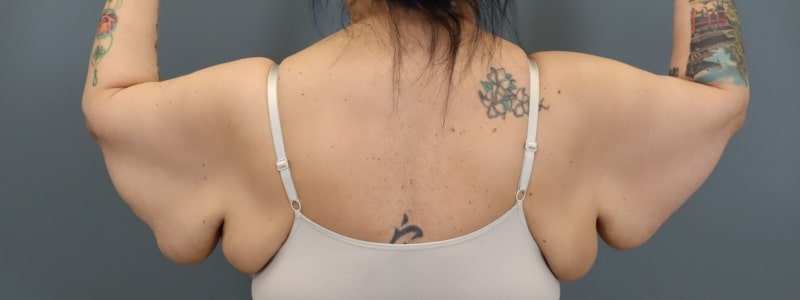 before arm lift bent back view female patient 5814