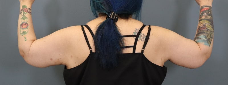 after arm lift bent back view female patient 5814