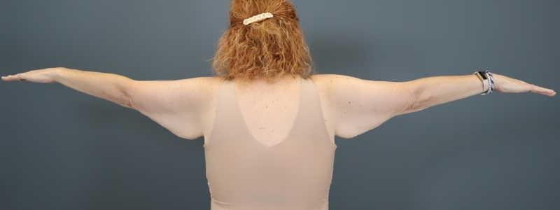 before arm lift straight back view of female patient 5817