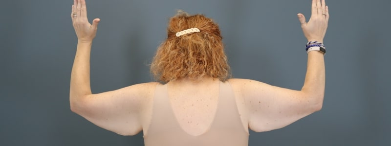 before arm lift bent back view of female patient 5817