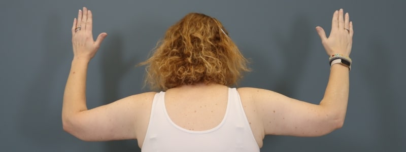 after arm lift bent back view of female patient 5817