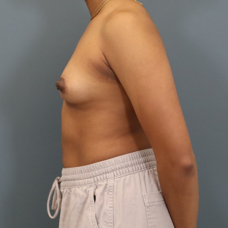 before breast augmentation left side view of female patient 5792