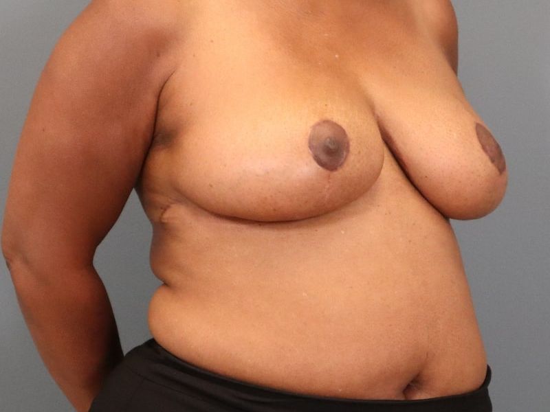 after breast reduction right angle view of female patient 5827 close up