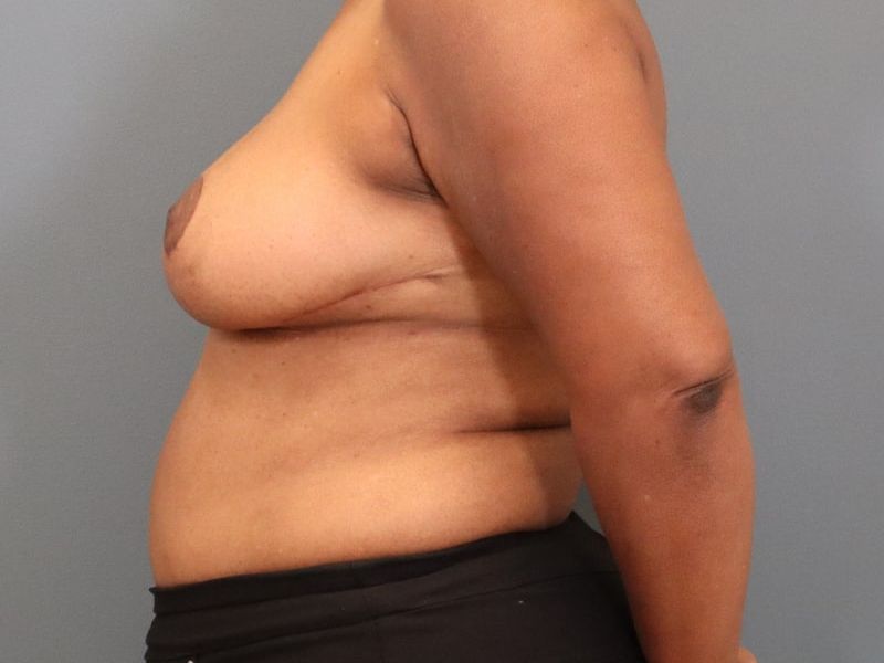 after breast reduction left side view of female patient 5827 close up