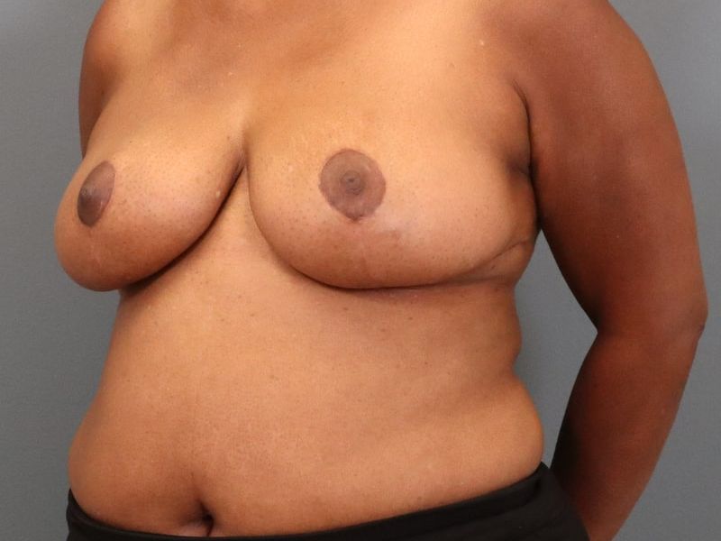 after breast reduction left angle view of female patient 5827 close up