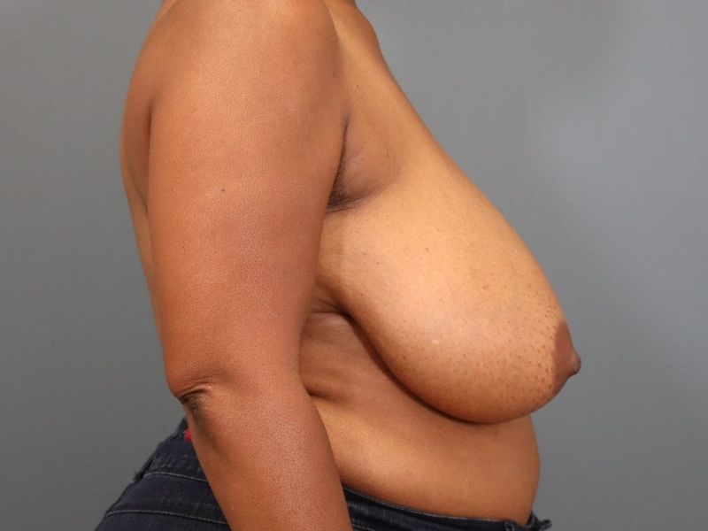 before breast reduction right side view of female patient 5827 close up